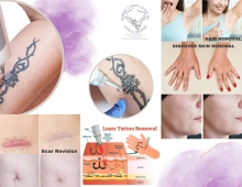 Tat hair removal